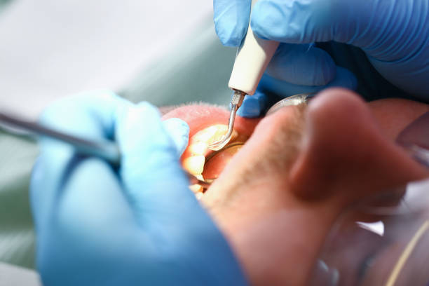 Best Dentist for Tooth Abscess  in White Center, WA